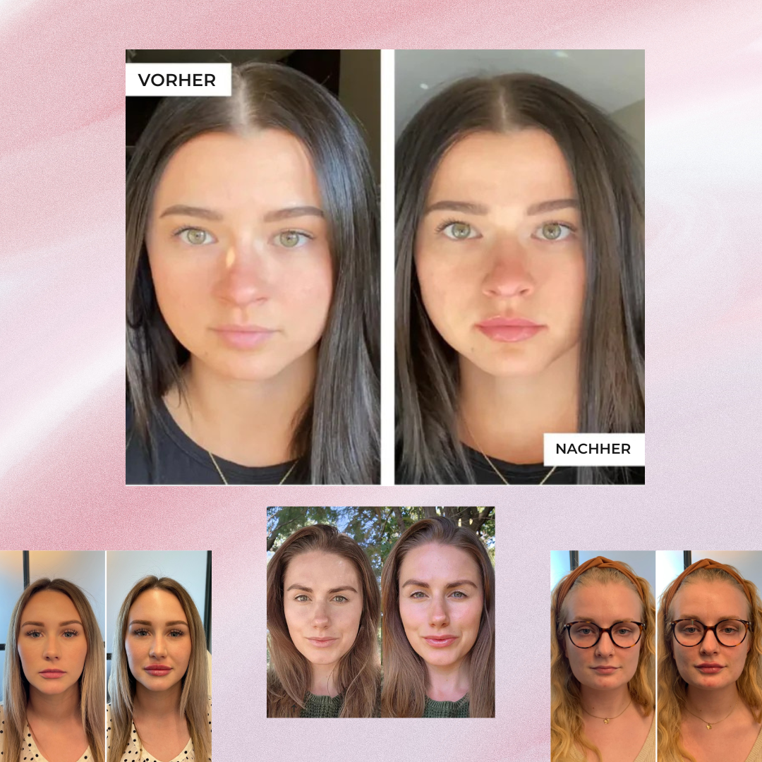 FEMINORA® Dermalip